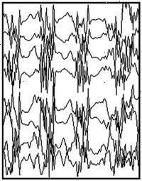 Convulsión generalizada EEG