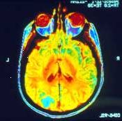 Una resonancia magnética del cerebro puede mostrar si el cáncer se ha diseminado (metástasis) allí.