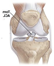 Vista frontal de la rodilla que muestra conjunta músculos, los huesos y ligamentos con rip parcial del ligamento cruzado anterior.