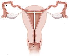 Sección transversal del útero y la vagina que muestra DIU colocado dentro del útero.