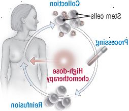 Procedimiento de trasplante de células madre