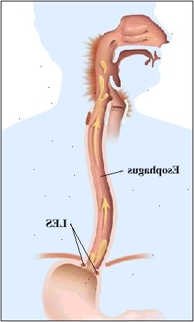 Contorno de una figura humana que muestra la anatomía del sistema digestivo superior, desde la boca hasta el estómago. Esófago pasa a través del diafragma para conectarse al estómago. Débil LES está abierto y las flechas muestran el movimiento de los contenidos estomacales hacia arriba en el esófago y la parte posterior de la garganta. Parte posterior de la garganta está inflamada.