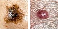 Fotografia comparando un lunar normal y melanoma enseñado asimetría