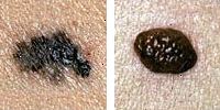 Fotografia comparando un lunar normal y melanoma enseñado bordes irregulares