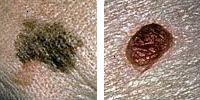 Fotografia comparando un lunar normal y melanoma enseñado diámetro