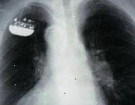 De rayos X de una sola cámara-implantado marcapasos