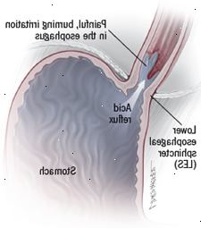 Ilustración Acidez estomacal