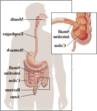 Cualquier parte del tracto digestivo, desde la boca hasta el ano, puede verse afectada. Se encuentra a menudo en el intestino y en el colon pequeña reunión.