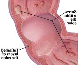 La enfermedad de Crohn puede afectar a todas las capas del tracto digestivo.