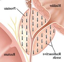 Sección transversal del primer de la vejiga, la próstata y el recto. Las semillas radioactivas son implantadas en toda la próstata.