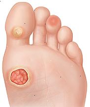 Planta del pie que muestra úlcera en la planta del pie, callos en la base del dedo gordo del pie, y el punto caliente en la almohadilla del tercer dedo del pie.