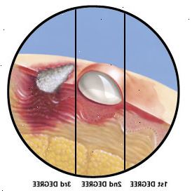 La sección transversal de la piel que muestra en primer grado a quemar la capa superior perjudicial de piel, quemaduras de segundo grado profundas capas dañinos de la piel y la formación de ampollas y quemaduras de tercer grado la destrucción de las capas superiores de la piel y los tejidos profundos perjudiciales.