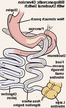 Vista frontal del estómago y el duodeno. Estómago se ha cortado y grapado. Corte el extremo del intestino delgado ha sido criado para conectarse al estómago. Duodeno ha sido cortado y vuelto a unir al intestino delgado. La flecha muestra la comida pasa del estómago al intestino delgado acortado. Otra flecha muestra el camino de los jugos digestivos del estómago a través del duodeno y en el intestino delgado. La digestión comienza en el intestino delgado.