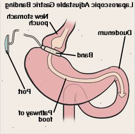 Vista frontal del estómago y el duodeno que muestra la banda gástrica ajustable por laparoscopia. Band es de alrededor de la parte superior del estómago, creando pequeña bolsa. Band está conectado mediante un tubo al puerto justo debajo de la piel. La flecha muestra trayecto de los alimentos a través de bolsa del estómago, el estómago y el duodeno.