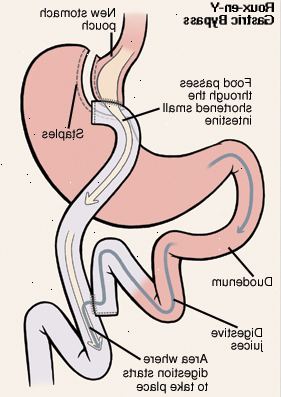 Vista frontal del estómago y el duodeno. Estómago se ha cortado y grapado para formar la bolsa. Corte el extremo del intestino delgado ha sido criado para conectarse a bolsa del estómago. Duodeno ha sido cortado y vuelto a unir al intestino delgado. La flecha muestra la comida pasa del estómago al intestino delgado acortado. Otra flecha muestra el camino de los jugos digestivos del estómago a través del duodeno y en el intestino delgado. La digestión comienza en el intestino delgado.