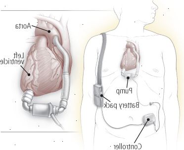 Dispositivo de asistencia ventricular (VAD)