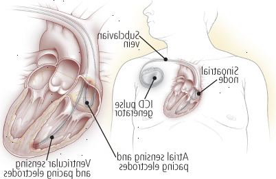 Desfibriladores cardíacos implantables