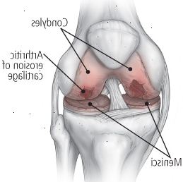 La osteoartritis de la rodilla