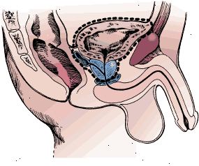 Límites quirúrgicos de la cistectomía radical en un hombre. La muestra incluye la vejiga, de la próstata, y las vesículas seminales.