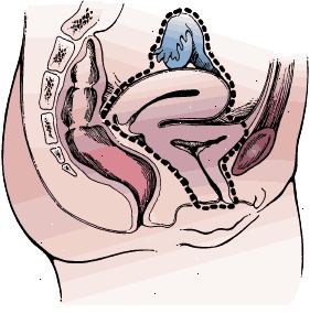 Límites quirúrgicos de la cistectomía radical en una mujer. La muestra incluye la vejiga y la uretra entero, útero, ovarios, trompas de Falopio, y la pared anterior de la vagina.