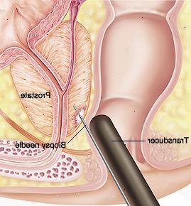 Sección transversal del primer de la próstata y el recto. Transductor se inserta en el recto y la aguja se inserta en la próstata.