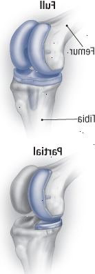 El reemplazo de rodilla