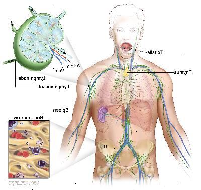 Sistema linfático; dibujo muestra los vasos linfáticos y los órganos linfáticos, incluso los ganglios linfáticos, las amígdalas, el timo, el bazo y la médula ósea. Un recuadro muestra la estructura interior de un ganglio linfático y de los vasos linfáticos adjuntos, con flechas que indican como circula la linfa (un líquido claro) hacia adentro y afuera del ganglio linfático. Otro recuadro muestra una vista ampliada de la médula ósea con células sanguíneas.