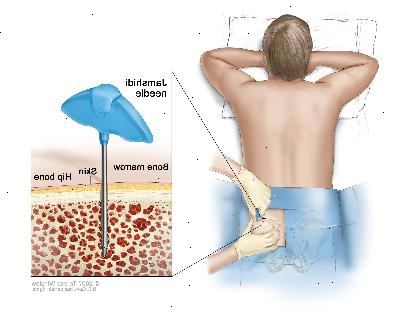 Aspiración de médula ósea y biopsia; dibujo muestra a un paciente acostado boca abajo en una camilla y una aguja de Jamshidi (una aguja larga y hueca) que se inserta en el hueso de la cadera. El recuadro muestra la aguja de Jamshidi que se inserta a través de la piel hasta la médula ósea del hueso de la cadera.