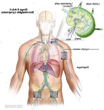 Adultos en estadio II del linfoma no hodgkin, imagen muestra el cáncer en grupos de ganglios linfáticos por encima y por debajo del diafragma. En un recuadro se observa un ganglio linfático con un vaso linfático, una arteria y una vena. Células de linfoma que contienen cáncer se muestran en el ganglio linfático.