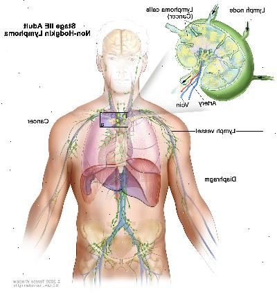 Adultos en estadio IIE linfoma no hodgkin, dibujo muestra cáncer en un grupo de ganglios linfáticos por encima del diafragma y en el pulmón izquierdo. En un recuadro se observa un ganglio linfático con un vaso linfático, una arteria y una vena. Células de linfoma que contienen cáncer se muestran en el ganglio linfático.