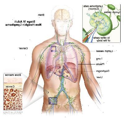 En adultos en estadio IV del linfoma no hodgkin, dibujo muestra un cáncer en el hígado, el pulmón izquierdo y en un grupo de ganglios linfáticos por debajo del diafragma. También se muestran el cerebro y la pleura. Un recuadro muestra un primer plano de cáncer que se disemina a través de los ganglios linfáticos y los vasos linfáticos a otras partes del cuerpo. Células de linfoma que contienen cáncer se muestran en el interior de un ganglio linfático. Otro recuadro muestra las células cancerosas en la médula ósea.