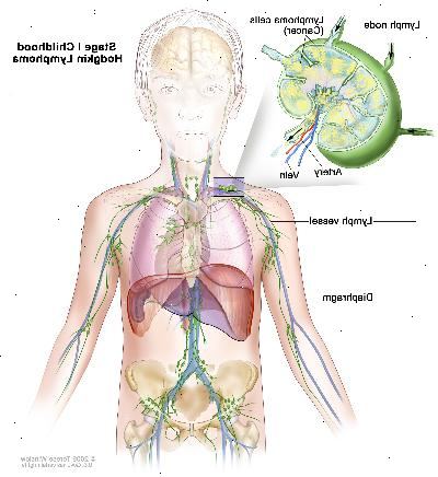 Etapa I linfoma de Hodgkin infantil; dibujo muestra cáncer en un grupo de ganglios linfáticos por encima del diafragma. En un recuadro se observa un ganglio linfático con un vaso linfático, una arteria y una vena. Células de linfoma que contienen cáncer se muestran en el ganglio linfático.