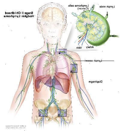 Etapa II linfoma de Hodgkin infantil, el dibujo muestra un cáncer en grupos de ganglios linfáticos por encima y por debajo del diafragma. En un recuadro se observa un ganglio linfático con un vaso linfático, una arteria y una vena. Células de linfoma que contienen cáncer se muestran en el ganglio linfático.