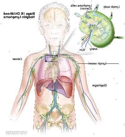 Etapa IIE linfoma hodgkin infancia; dibujo muestra cáncer en un grupo de ganglios linfáticos por encima del diafragma y en el pulmón izquierdo. En un recuadro se observa un ganglio linfático con un vaso linfático, una arteria y una vena. Células de linfoma que contienen cáncer se muestran en el ganglio linfático.