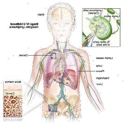 Etapa IV infancia hodgkin; dibujo muestra un cáncer en el hígado, el pulmón izquierdo y en un grupo de ganglios linfáticos por debajo del diafragma. También se muestran el cerebro y la pleura. Un recuadro muestra cáncer que se disemina a través de los ganglios linfáticos y los vasos linfáticos a otras partes del cuerpo. Células de linfoma que contienen cáncer se muestran en el interior de un ganglio linfático. Otro recuadro muestra las células cancerosas en la médula ósea.