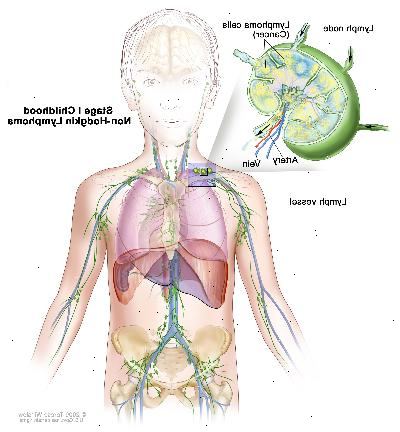 Etapa I infancia linfoma no hodgkin, dibujo muestra un cáncer en un grupo de ganglios linfáticos. En un recuadro se observa un ganglio linfático con un vaso linfático, una arteria y una vena. Células de linfoma que contienen cáncer se muestran en el ganglio linfático.