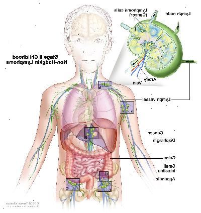 Etapa II infancia linfoma no hodgkin, imagen muestra el cáncer en grupos de ganglios linfáticos por encima y por debajo del diafragma, en el hígado y en el apéndice. También se muestra el colon y el intestino delgado. En un recuadro se observa un ganglio linfático con un vaso linfático, una arteria y una vena. Células de linfoma que contienen cáncer se muestran en el ganglio linfático.