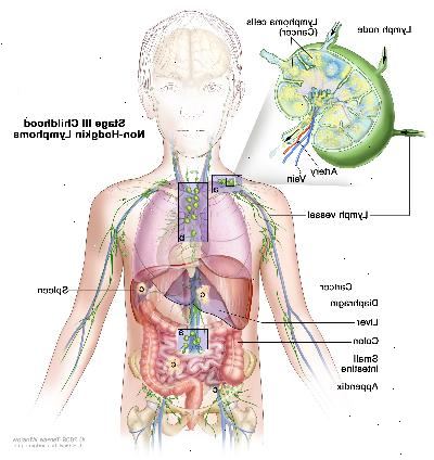 Etapa III infancia linfoma no hodgkin, imagen muestra el cáncer en grupos de ganglios linfáticos por encima y por debajo del diafragma, en el pecho, y en todo el abdomen, en el hígado, el bazo, el intestino delgado y el apéndice. También se muestra el colon. En un recuadro se observa un ganglio linfático con un vaso linfático, una arteria y una vena. Células de linfoma que contienen cáncer se muestran en el ganglio linfático.