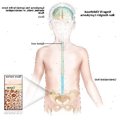 Etapa IV infancia linfoma no hodgkin, el dibujo muestra el cerebro, la médula espinal y el líquido cefalorraquídeo en y alrededor del cerebro y la médula espinal. Un recuadro muestra el cáncer en la médula ósea.