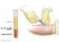 Recuento sanguíneo completo (CBC). La sangre se recoge mediante la inserción de una aguja en una vena y permitir que la sangre fluya hacia un tubo. La muestra de sangre se envía al laboratorio y los glóbulos rojos, los glóbulos blancos y las plaquetas. El RSC se usa para examinar, diagnosticar y vigilar muchas enfermedades diferentes.