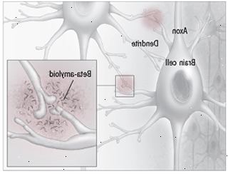 Placas de beta-amiloide