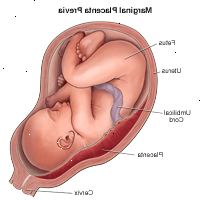Ilustración de placenta previa marginal