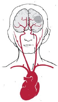 Corazón, el cerebro, los triglicéridos, el accidente cerebrovascular