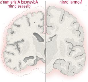Cambios cerebrales en la enfermedad de alzheimer
