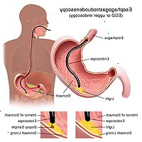 Ilustración de un procedimiento de esofagogastroduodenoscopia