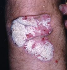 Psoriasis