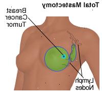 Ilustración de una mastectomía total