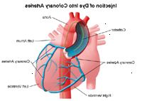 Ilustración de las arterias coronarias después de la inyección de un colorante utilizado en el cateterismo cardíaco o la ACTP