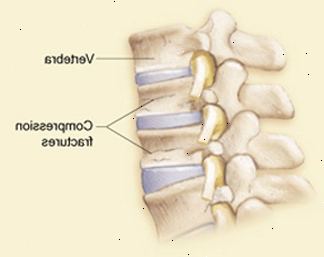 Vista lateral de las vértebras y los discos que muestran las fracturas por compresión de las vértebras.
