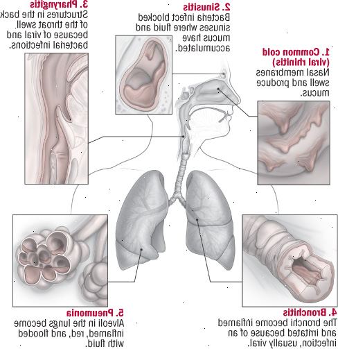 Cinco infecciones del tracto respiratorio